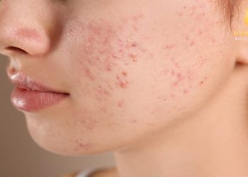 cách điều trị mụn trứng cá