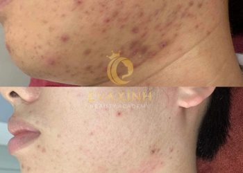 đào tạo nghề trị mụn